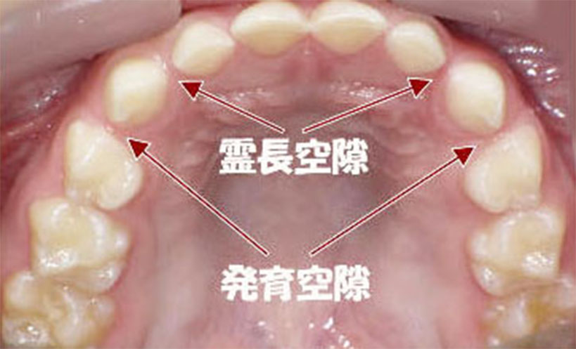 上顎乳歯列に発育空隙と霊長空隙