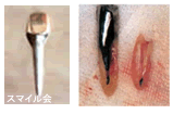 左：金属の土台、右：歯根が割れて抜歯