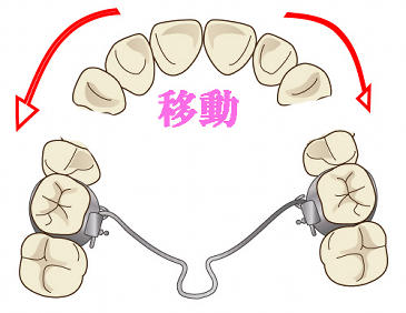 トランスパラタルアーチを抜歯矯正に使用
