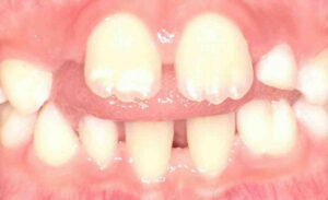 舌で歯を押す癖・舌突出癖を治す方法