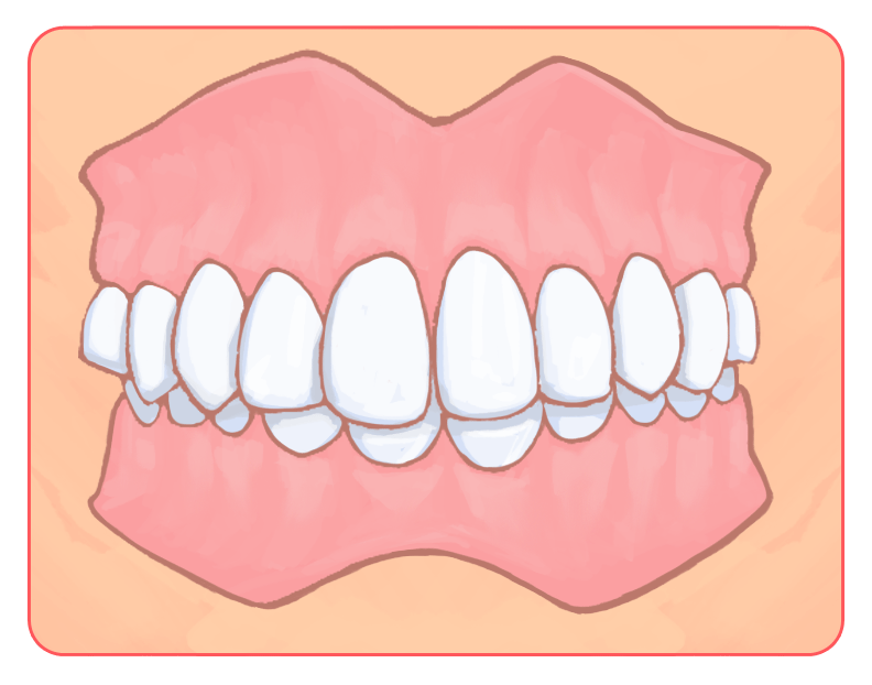 過蓋咬合（噛み合わせが深い）