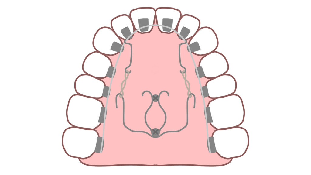 裏側矯正（リンガル矯正）