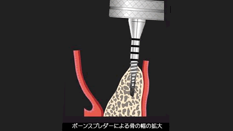 ボーンスプレッダーでインプラントを埋入する部位の骨を段階的に拡大