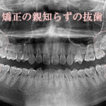 歯列矯正で親知らず抜歯の必要性