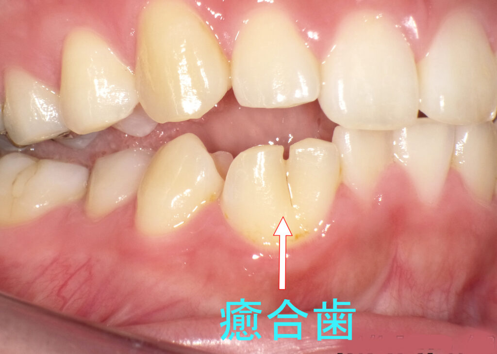 下顎永久歯の犬歯と側切歯の癒合歯