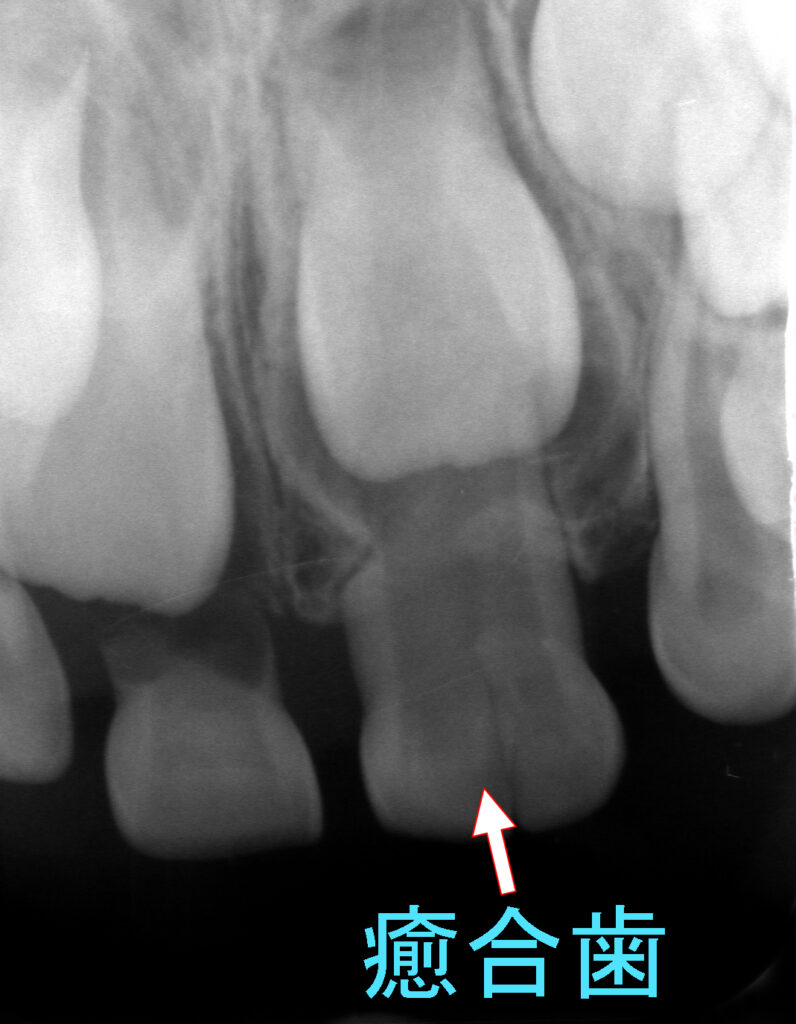 癒合歯のレントゲン写真