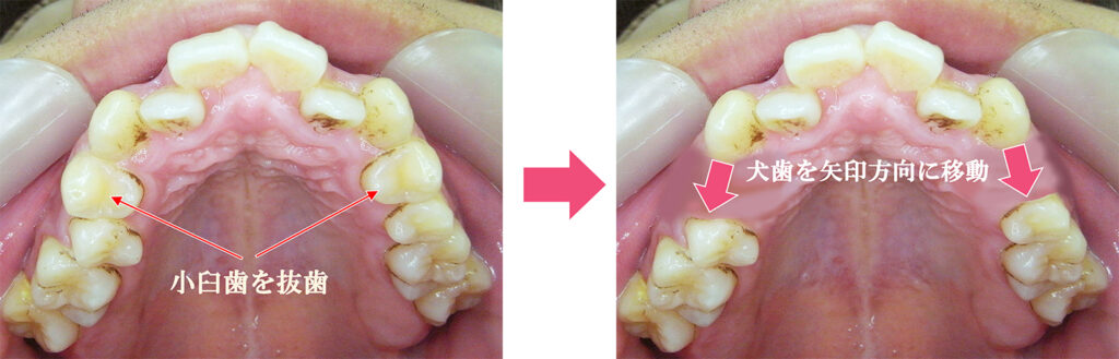 抜歯矯正