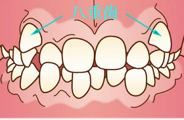 狭窄歯列弓で八重歯
