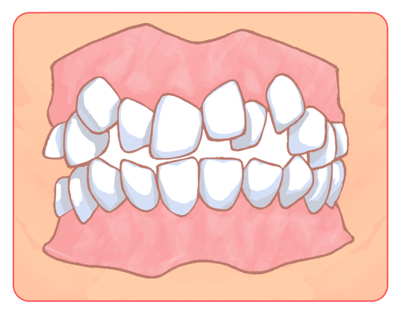 八重歯・ガタガタの歯並び（叢生）