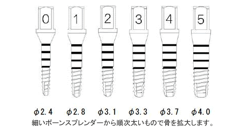 ボーンスプレッダーの種類