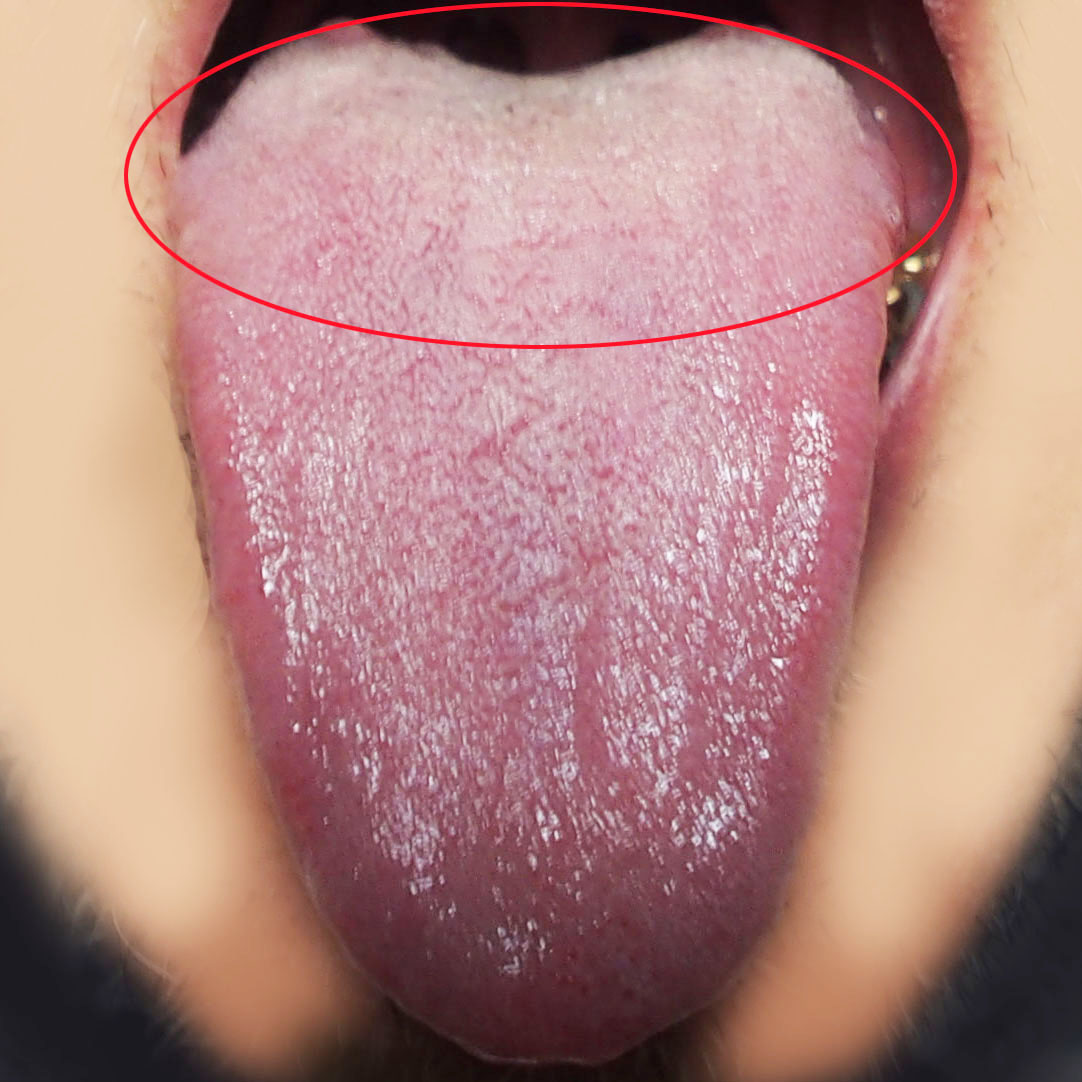 健康な白い舌苔
