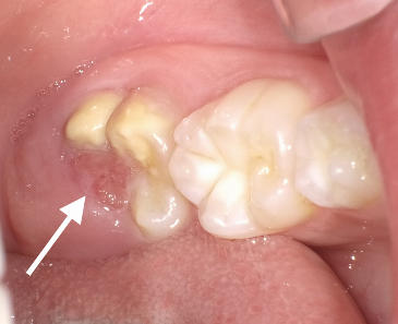 萌出性歯肉炎が原因の歯茎出血