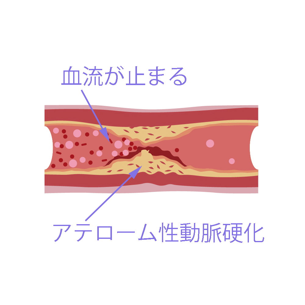 アテローム動脈硬化 | 動脈硬化 起こりやすい部位 | 【動脈硬化】 メタボが血管の老化現象を加速する – FPSN