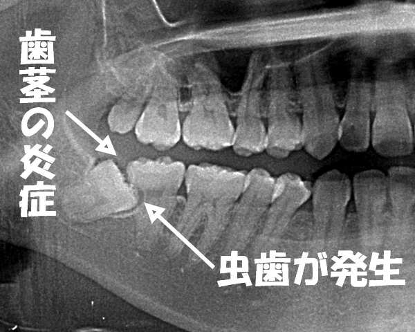 智歯周囲炎が原因の歯茎の腫れ