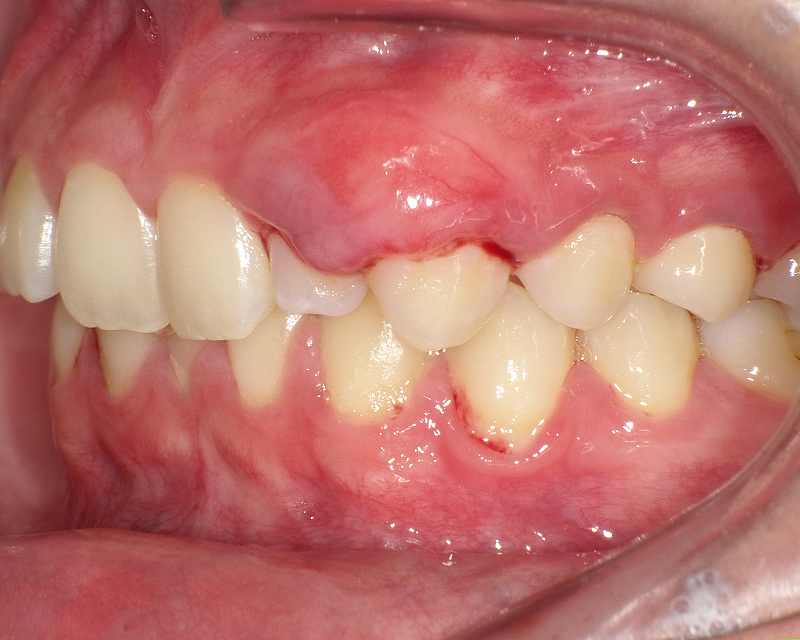 侵襲性歯周炎が原因の歯茎出血