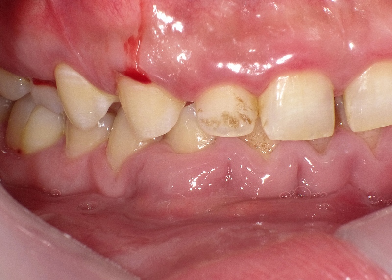 薬物性歯肉増殖症が原因の歯茎出血