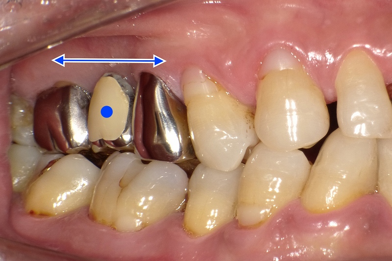 奥歯保険適用ブリッジ側面観