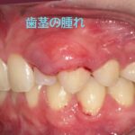 歯茎が腫れる原因と治し方