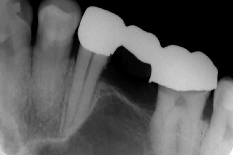 奥歯保険適用ブリッジレントゲン写真