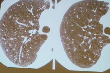 肺気腫のレントゲン写真