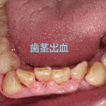 歯茎から血が出る原因と対処法