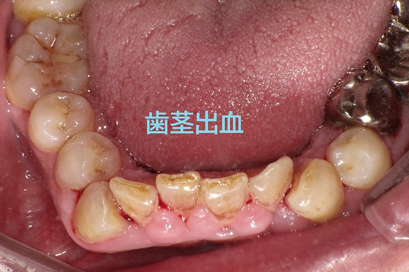 歯茎の出血原因, 何もしてないのに歯茎から血が出る – CEQP