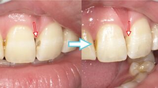 保険適用で白い歯】コンポジットレジンとは？メリット・デメリット