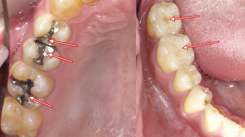 保険でできるインレー治療と自費の違い｜後悔しない素材選びとは？
