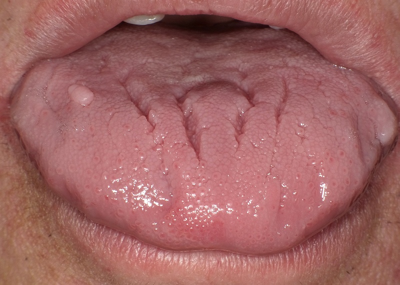 舌の上面に出来た線維腫