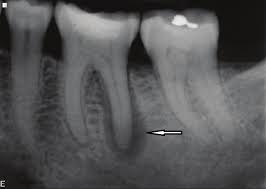 歯根膜腔の拡大
