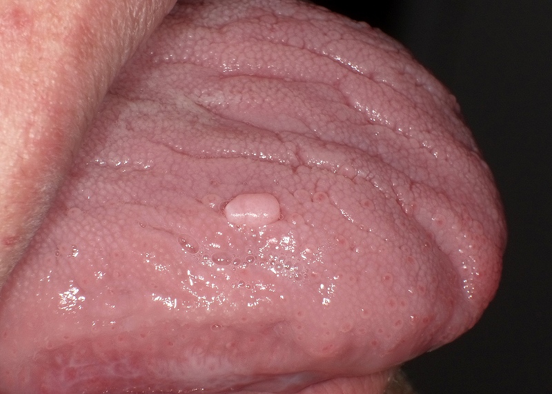 舌の線維腫側面観
