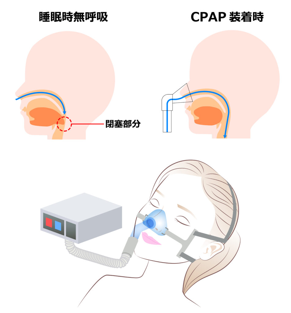 経鼻的持続陽圧呼吸療法（CPAP）