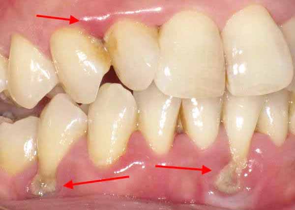歯周病の重症化
