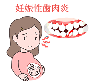 妊娠性歯肉炎が原因の歯茎出血