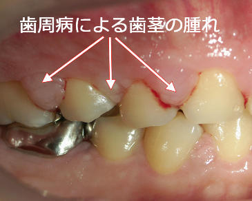 歯周病が原因の歯茎の腫れ
