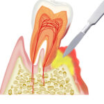 P急発-歯周病の急性発作