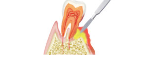 P急発-歯周病の急性発作