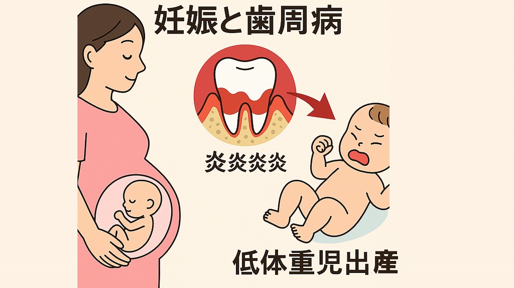 妊娠と歯周病:低体重児出産との関係