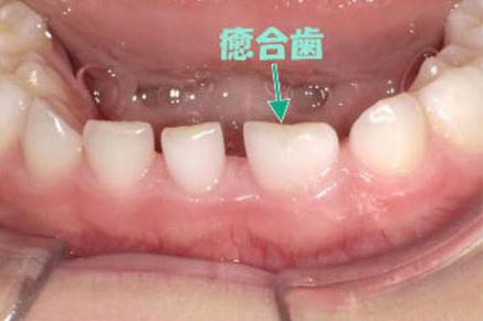 乳歯の癒合歯