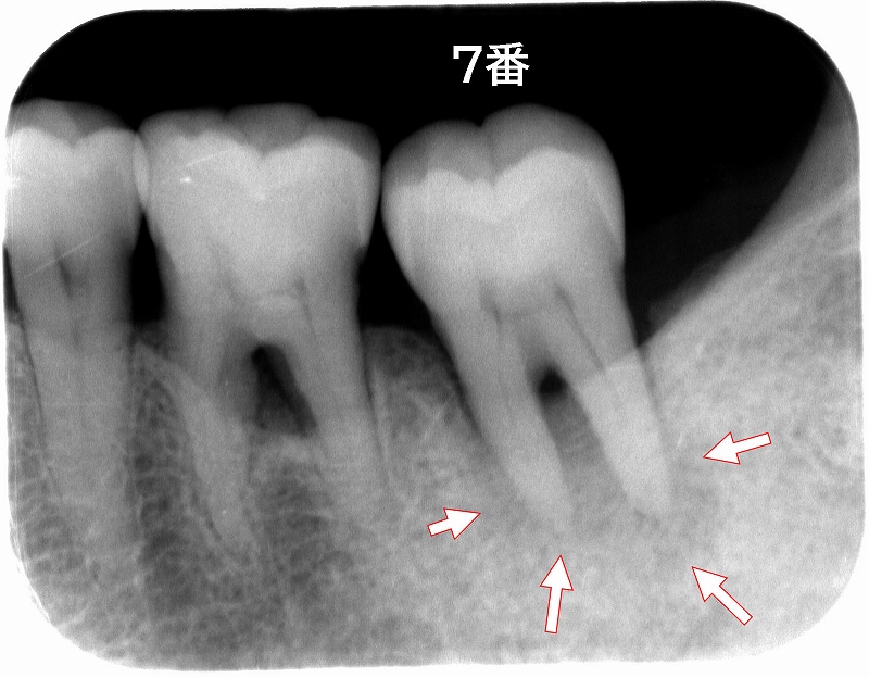 歯周病の手遅れ症状