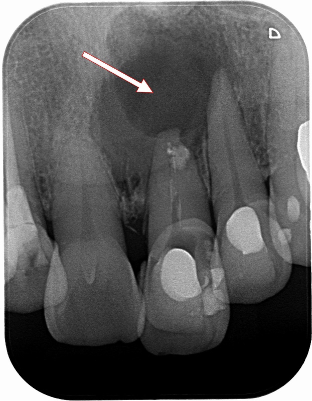 歯根嚢胞の大きさ確認