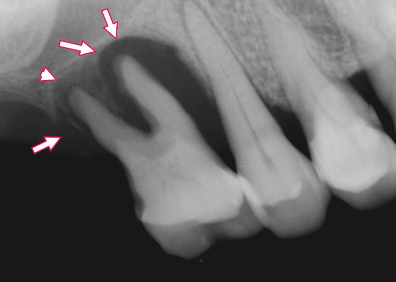 右上顎6番が重度歯周病のレントゲン画像