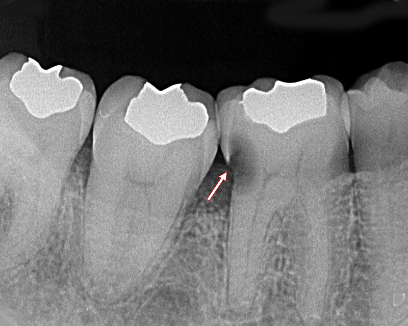下顎奥歯６番の歯間部の虫歯