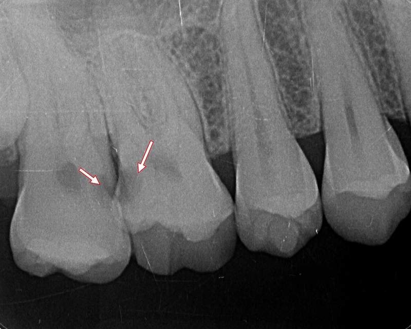 奥歯6番と７番の歯間部の虫歯