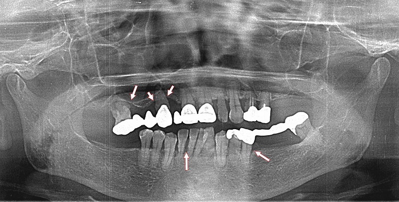 重度歯周病の歯槽骨の吸収