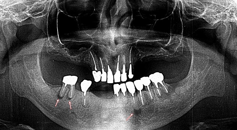 下顎6番と 下顎3番に歯根嚢胞