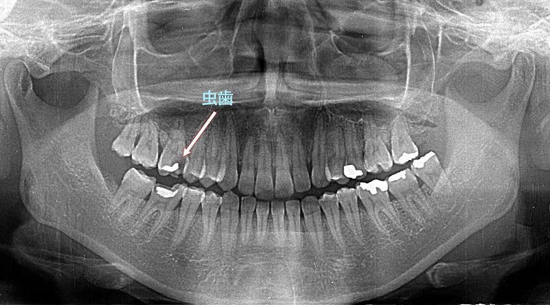 上顎6番に神経まで到達する虫歯
