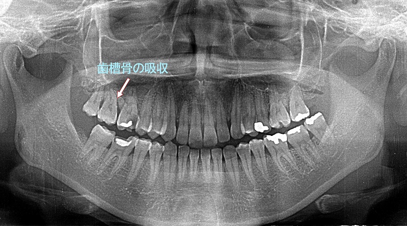 中程度歯周病による歯槽骨の吸収