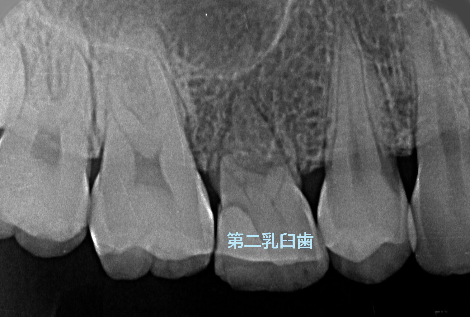 後続永久歯の先天欠損