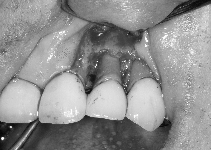 歯周外科・フラップ手術